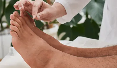 Acupuncture Treatment at Rapharehab Etobicoke