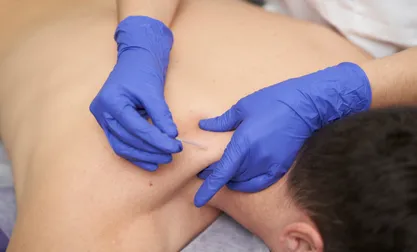Cupping & Dry Needling | Rapharehab